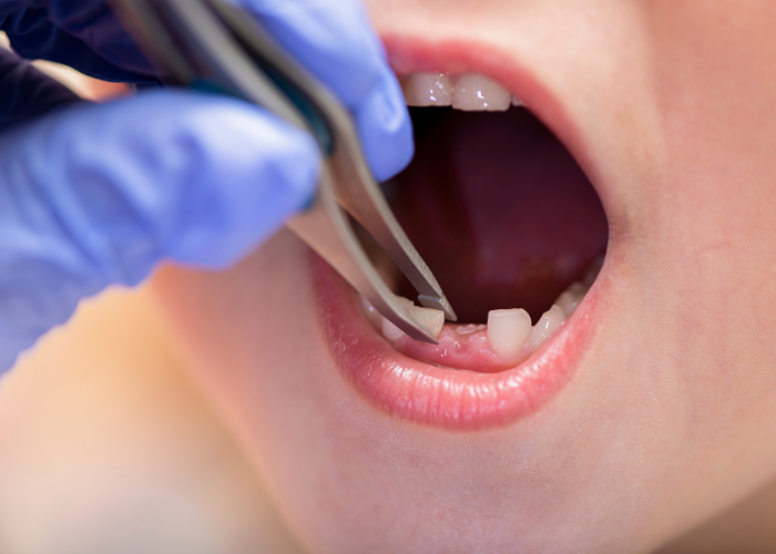 extractions and preservations austin dental specialty group