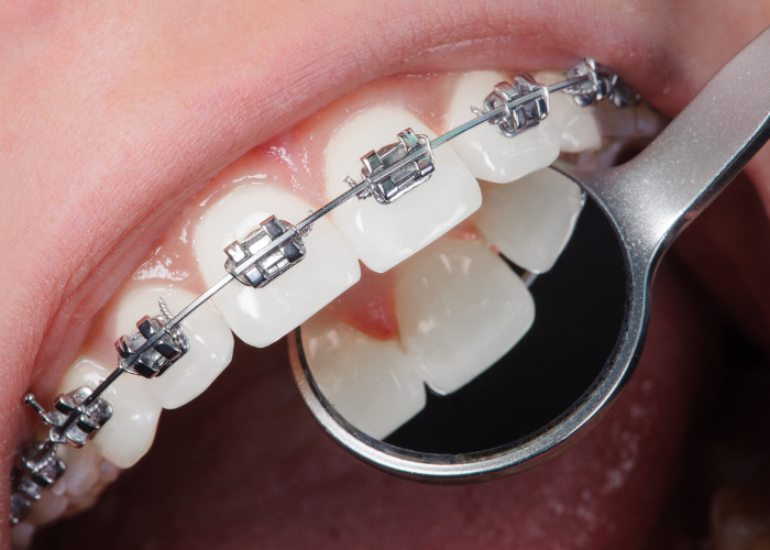 orthodontics austin dental specialty group