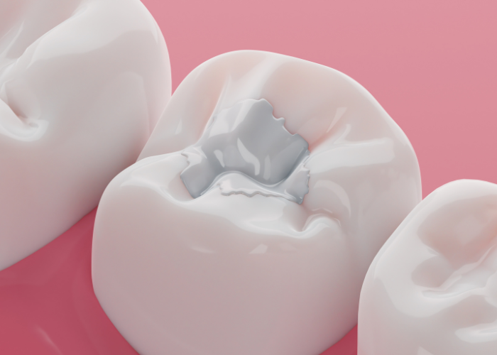 Composite filling in a tooth cavity, showcasing tooth-colored restoration against a pink background, illustrating cosmetic dentistry solutions for dental health.