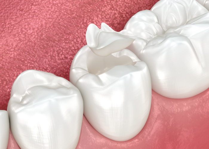 3D rendering of dental onlays applied to molars, showcasing restoration technique for damaged teeth, relevant to cosmetic dentistry services offered by Austin Dental Specialty Group.