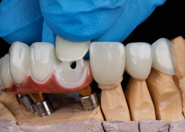 Porcelain veneers being applied to a dental model, showcasing cosmetic dentistry techniques for smile enhancement.