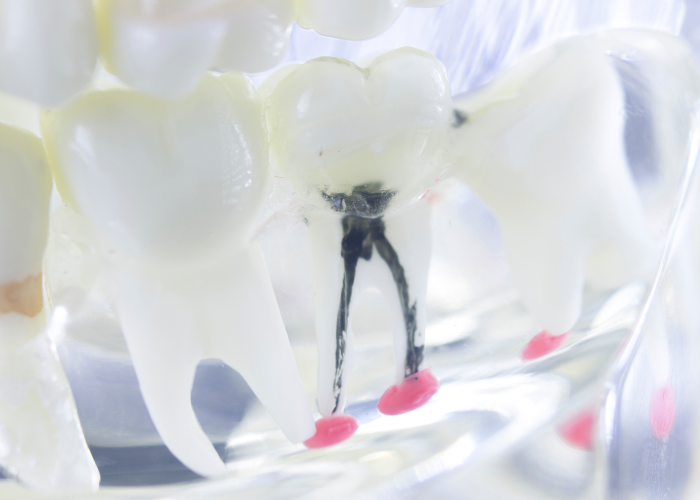 Illustration of a tooth model highlighting root canal anatomy with blackened root canal and red filling material, relevant to dental procedures and treatment options at Austin Dental Specialty Group.