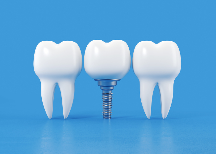 Porcelain dental implants with two adjacent natural teeth, illustrating tooth replacement solutions for enhanced oral health and aesthetics.